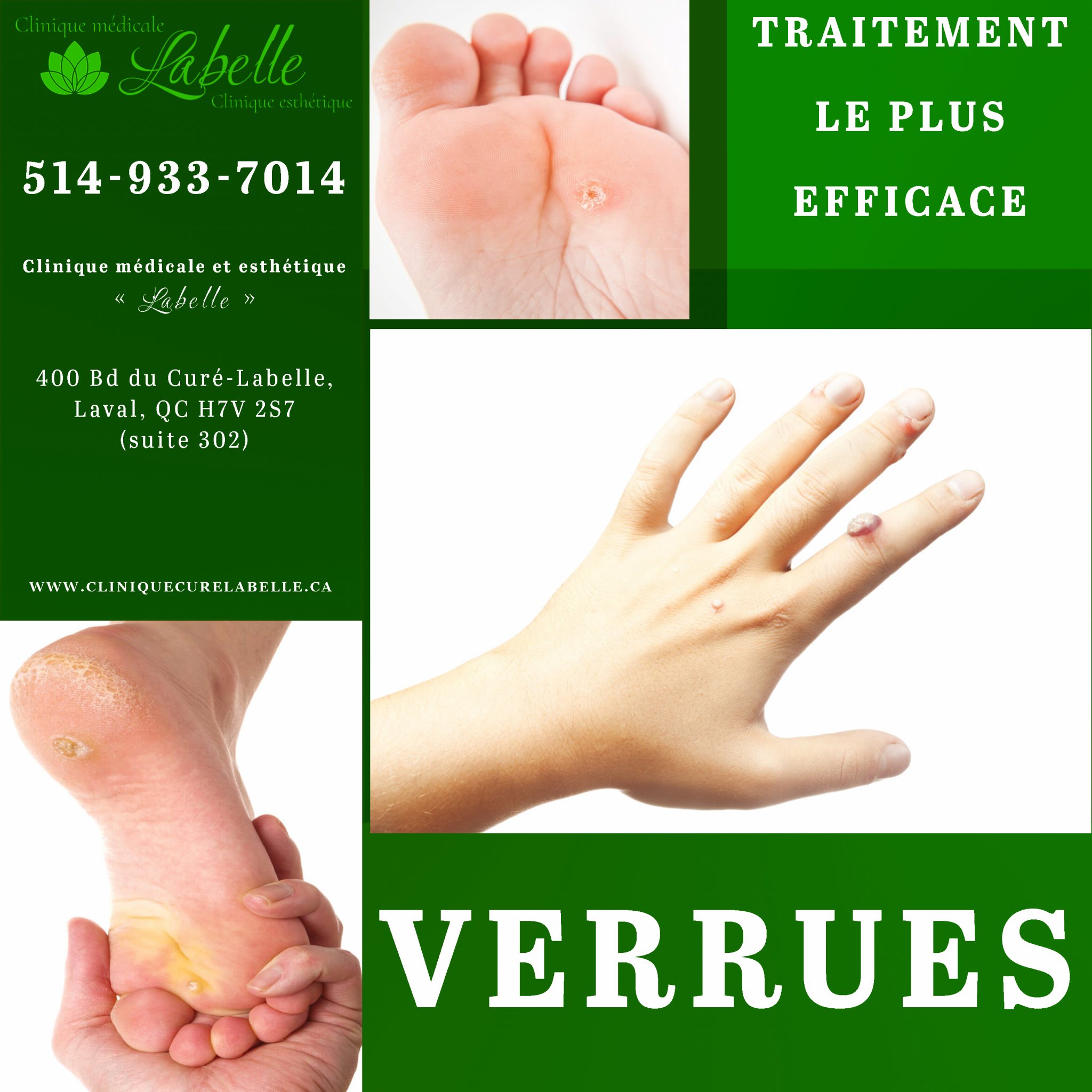 Comment retirer un verrue-Coût pour enlever un verrue-Traitement médical pour verrues-Enlever verrues sans douleur - Comment enlever un verrue-Traitement efficace pour les verrues-Enlever verrue à Laval et Montréal -Comment se débarrasser des verrues-Traitement des verrues au laser-Cryothérapie pour acrochordons Comment retirer un verrue-Coût pour enlever un verrue-Traitement médical pour verrues-Enlever verrues sans douleur - Comment enlever un verrue-Traitement efficace pour les verrues-Enlever verrue à Laval et Montréal -Comment se débarrasser des verrues-Traitement des verrues au laser-Cryothérapie pour acrochordons