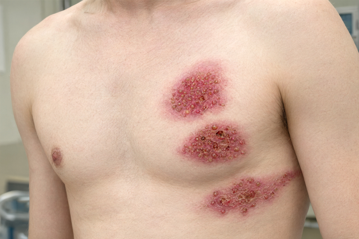 Pain, a burning sensation, or tingling may occur before the shingles (herpes zoster) rash appears. Clusters of blisters then develop, often on only one side of the body.