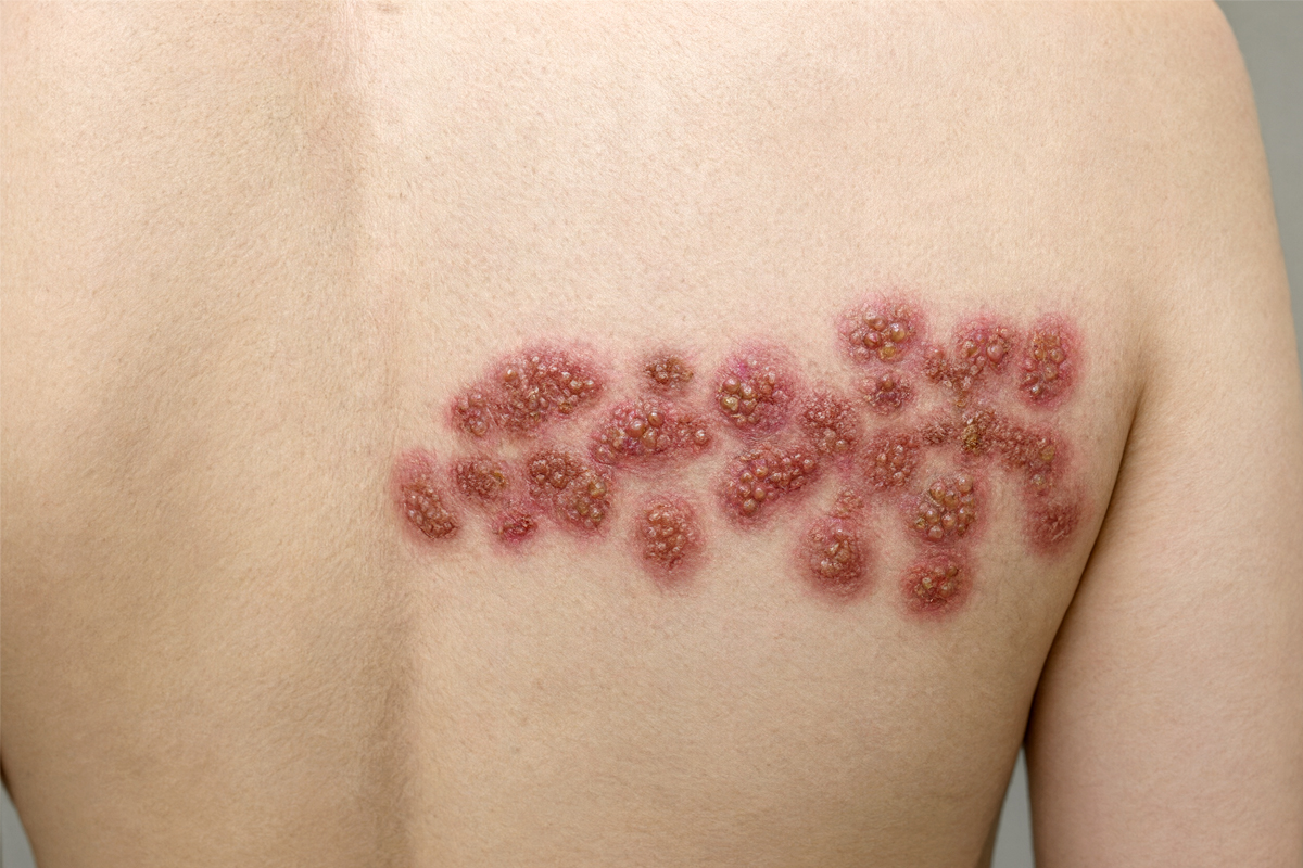 Zona zoster sur le dos d'un homme : eruption cutanee douloureuse avec vesicules et croutes, symptomes de zona, herpes zoster. Consultation medicale, diagnostic et traitement pour la zona a Laval et Montreal.
